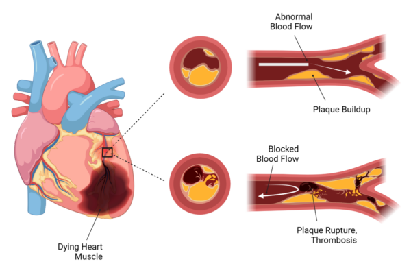 Coronary Artery Disease - Abcentra