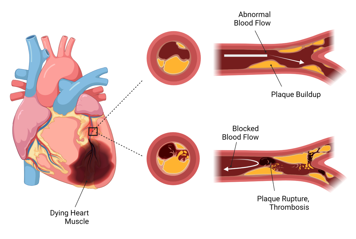 Graphic showing acute coronary syndrome's effect on the heart
